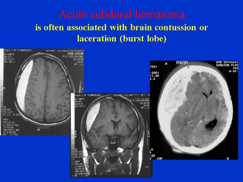 Acute subdural hematoma is often associated with brain contussion or laceration (burst lobe)
